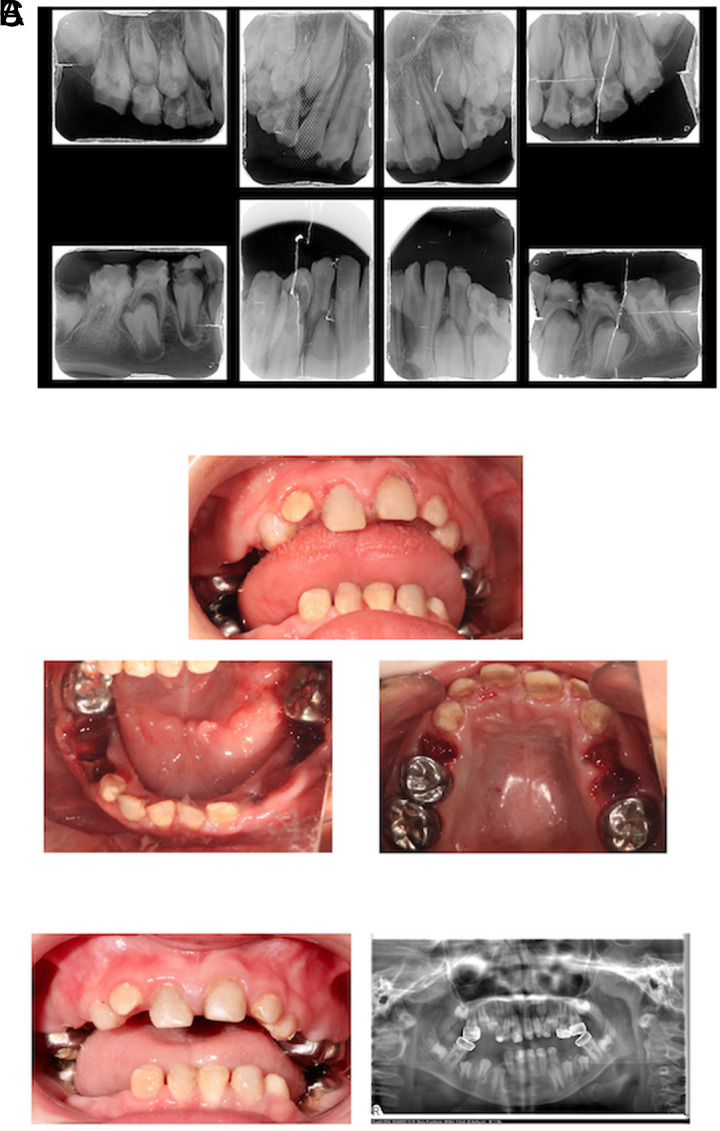 Kohlschütter-Tönz Syndrome: A Rare Clinical Entity with Amelogenesis Imperfecta in Two Siblings, Dental Management and Scoping Review.
