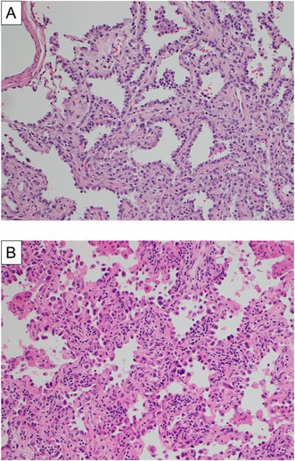 Correction to "Surgical Resection for Rare Cases of Lung Cancer in Teenagers".