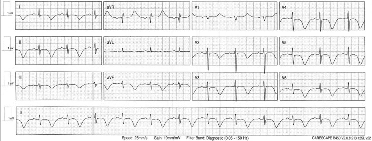 ECG challenge: inversion without infarction.
