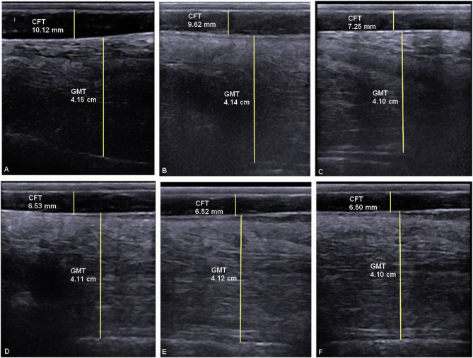 Ultrasound measurements of croup fat thickness and liver echogenicity as indicators for lipomobilization in donkeys (Equus Africanus asinus) with fasting-induced hyperlipidemia.