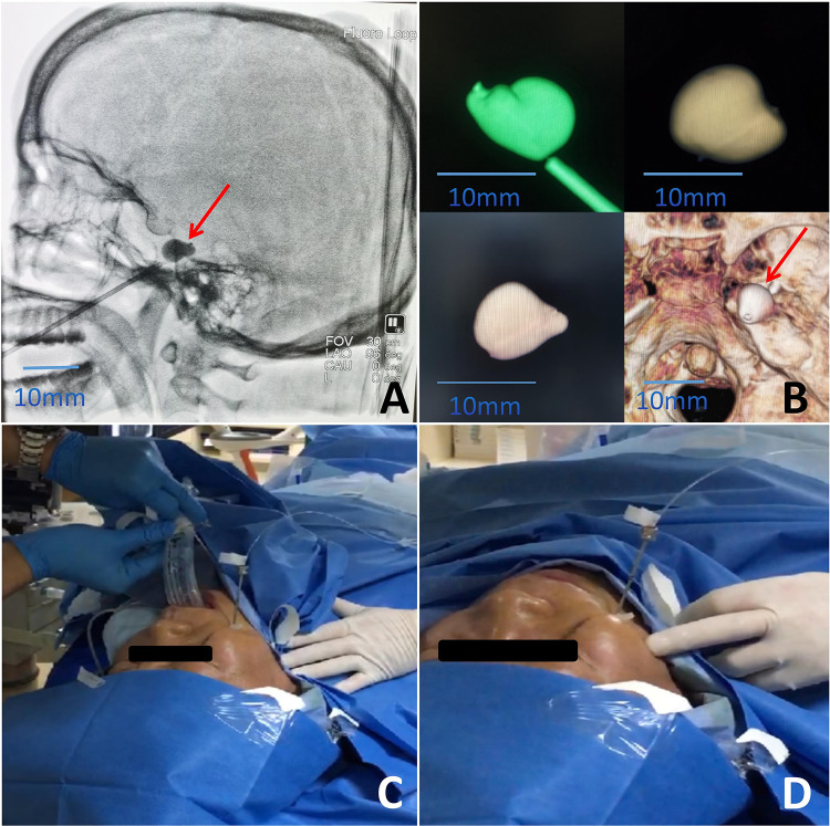 Application of Intraoperative Awake Anesthesia and Three-Dimensional Reconstruction Technique in Percutaneous Microballoon Compression for Trigeminal Neuralgia.