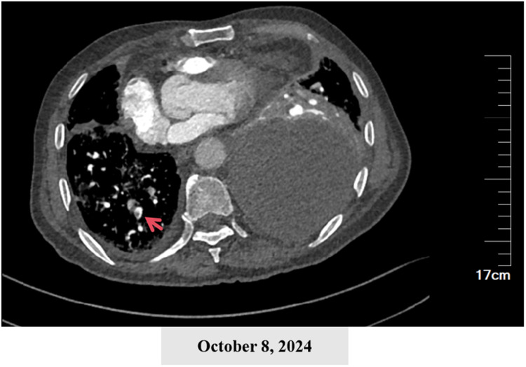 Metagenomic Next-Generation Sequencing Reveals <i>Porphyromonas gingivalis</i> in Geriatric Severe Pneumonia Complicated by Empyema: Case Report.