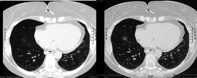 Simultaneous onset of systemic sclerosis and light chain amyloidosis: the first report of a case report and review of the literature.