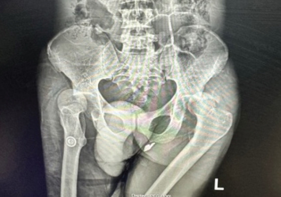 Asymmetrical Bilateral Complex Dislocations of the Hips: A Rare Case Report.