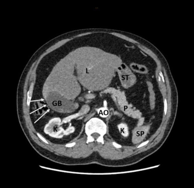Right Hepatic Lobe Hypoplasia and Gangrenous Cholecystitis: Surgical Implications and Case Report.