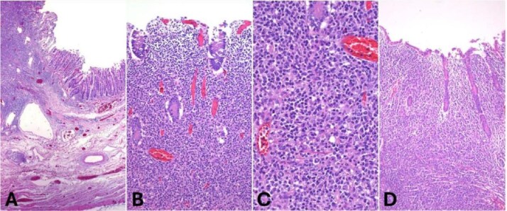 Primary colonic lymphoma: clinical dilemmas in diagnosis and treatment strategy.