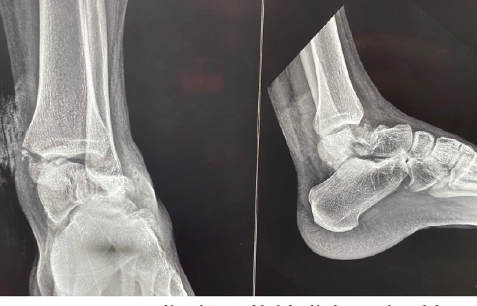 A Rare Case of Talus Neck and Open Medial Malleolus Fractures with Ankle Subluxation Treated using a Single Anteromedial Approach.