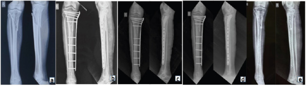 Low Profile, High Impact: External Fixation using Locking Plates in Challenging Tibial Fractures.