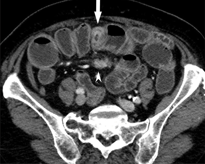 Neuroendocrine Small Bowel Tumor.