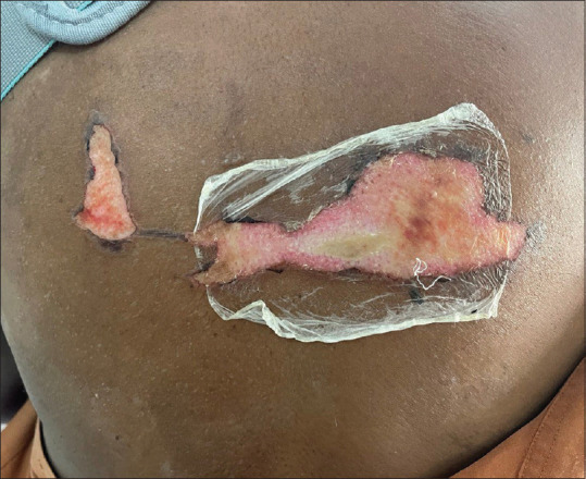 Second-Degree Burn From a Grounding Pad of Surgical Device During Surgery of Left Clavicle Fracture - Untoward, Unexpected Event.