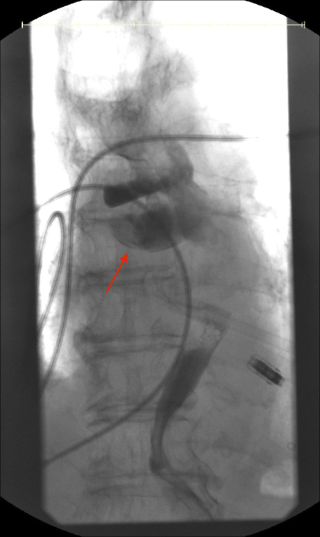 Esophageal Hematoma Following Transcatheter Edge-to-Edge Repair of the Mitral Valve: A Rare Complication of Transesophageal Echocardiography.