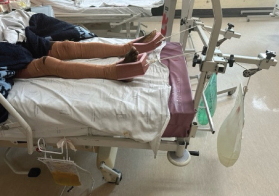 Asymmetrical Bilateral Complex Dislocations of the Hips: A Rare Case Report.