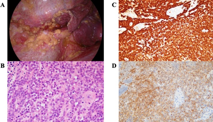 Radiotherapy-Induced Pleural Mesothelioma in a Childhood Leukaemia Survivor: A Case Report.