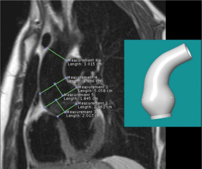 Personalized External Aortic Root Support (PEARS) in the Treatment of Marfan Syndrome and Bicuspid Aortic Valve Aneurysms: First Case Series in the American Continent.