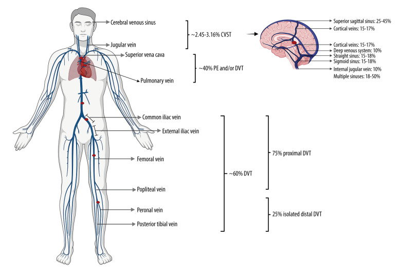Thrombotic Challenges at High Altitude: A Case Report of Cerebral, Pulmonary, and Ventricular Thrombosis in a 21-Year-Old.