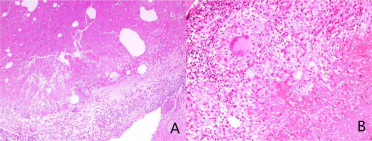 Integrative Medicine Treatment Strategy for Tuberculosis of the Breast Combined with Granulomatous Mastitis: A Case Report.
