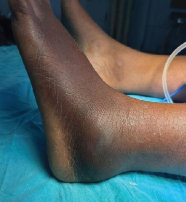 Calcaneal Giant Cell Tumor Masquerading as Lateral Ankle Sprain - A Rare Case Report and Review of Literature.