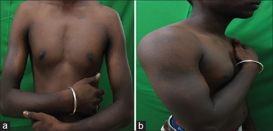 Familial Primary Cutaneous Amyloidosis Across Generations.
