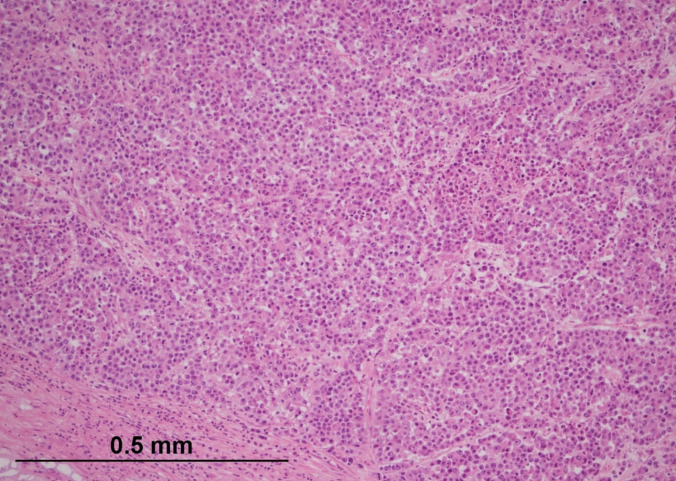 Medullary Carcinoma of the Colon: Not as Favourable as Previously Thought?