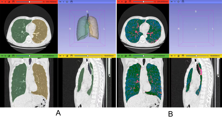 Quantitatively Assessed Emphysema Severity on HRCT Independently Predicts Coronary Artery Disease in COPD: A Retrospective Cohort Study.