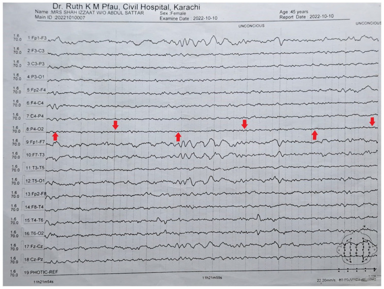 Beyond the Usual Features-Expanded Dengue Syndrome in Association With Possible Pre-existing Neurological Disease: A Case Report.