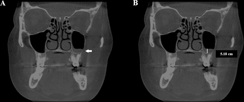 Is Concha Bullosa Associated with Nasal Septum Deviation and Mucosal Thickening of the Maxillary Sinuses? A Cone Beam Computed Tomography Study.