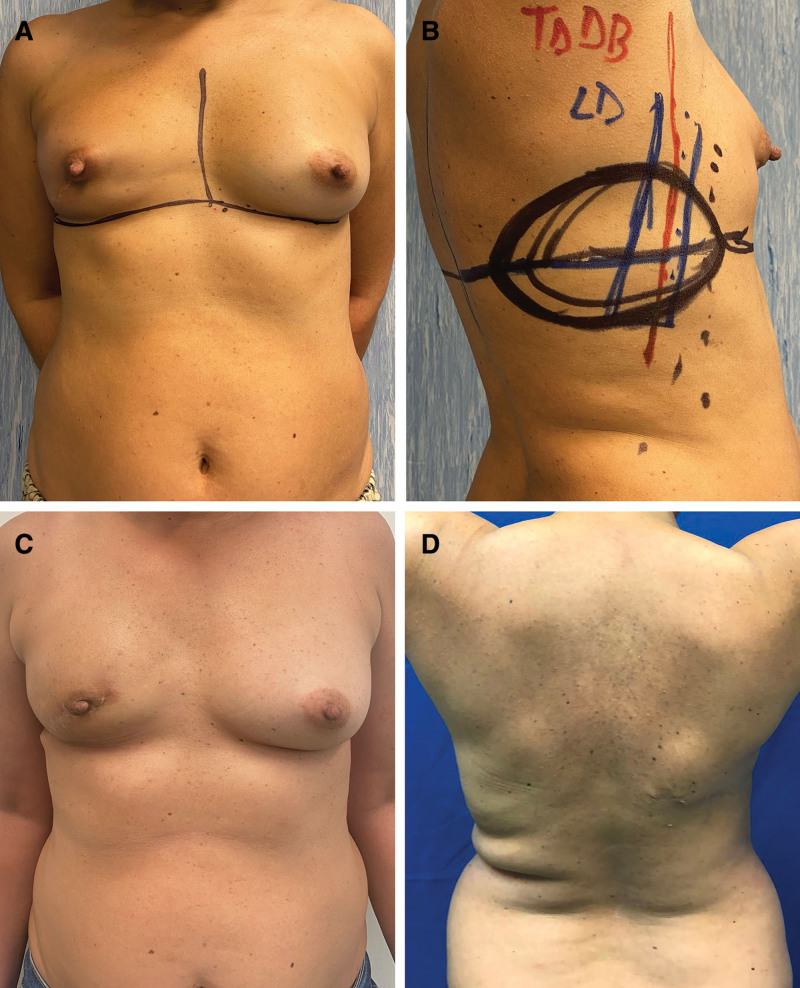 The Versatility of the Fat-extended, Muscle-sparing Latissimus Dorsi Flap in Breast Reconstruction.