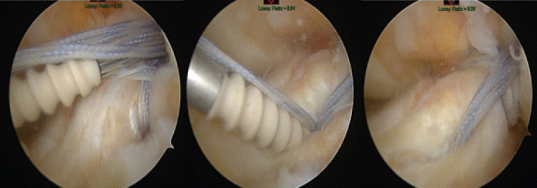 Inverted Cyclops Lesion Following Anterior Cruciate Ligament Repair: A Case Report.
