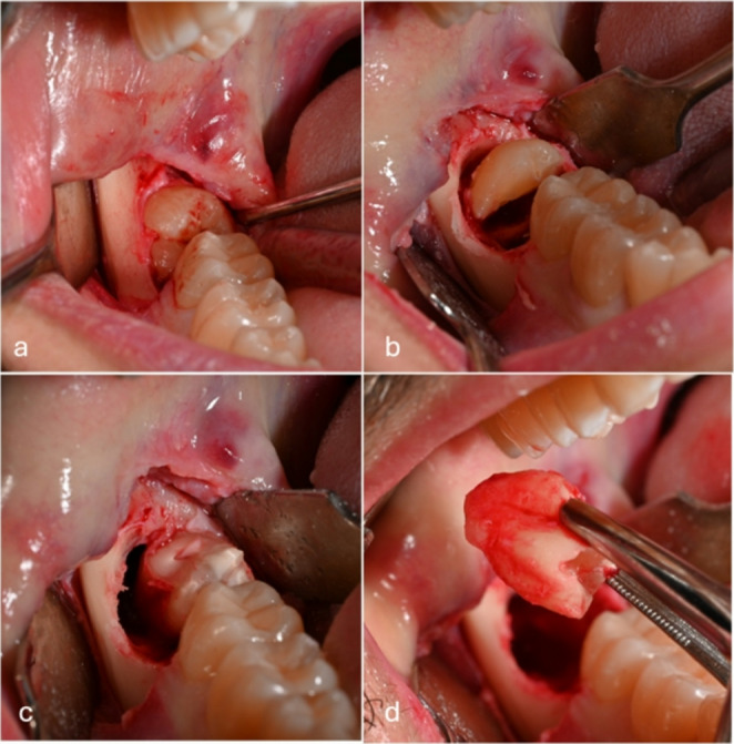 Using injectable Platelet-Rich fibrin to improve recovery after impacted lower third molar extraction: a randomized controlled clinical trial.