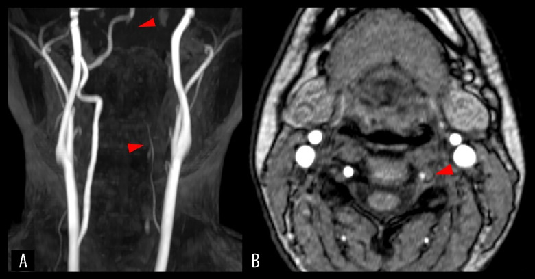 Vertebral Artery Dissection Induced by Fitness Video Game Exercise: A Case Report.