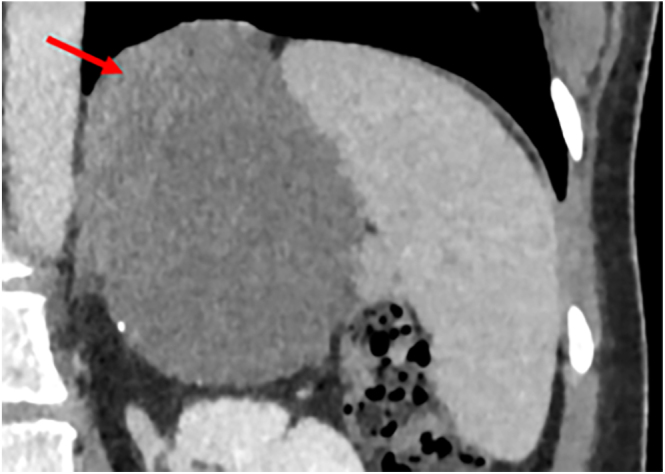 Retroperitoneal bronchogenic cyst masquerading as an adrenal incidentaloma.