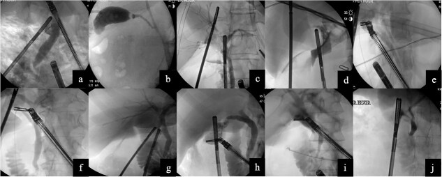 Robotic-assisted laparoscopic cholecystectomy with indocyanine green fluorescent cholangiography and intraoperative cholangiogram for patients with acute and chronic cholecystitis: a case series.