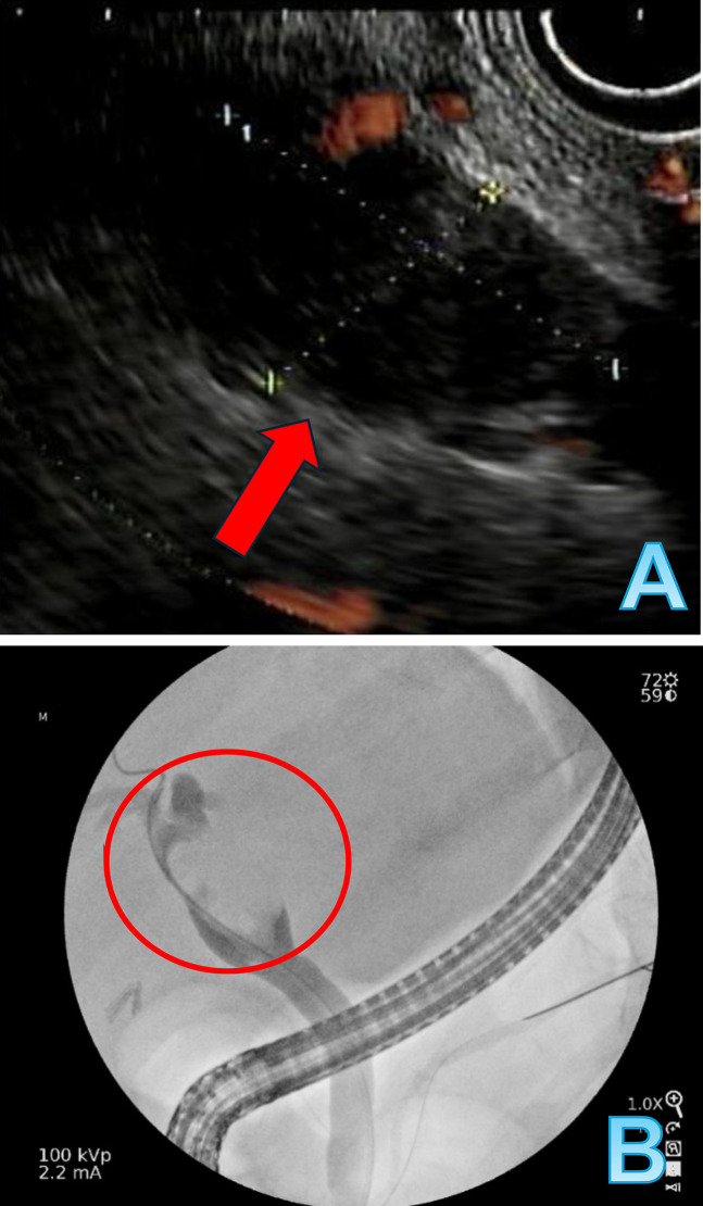 Diagnosis of Perihilar Osteoclast Giant Cell Carcinoma in an Elderly Patient: A Report of Diagnostic Challenges Over Several Attempts.