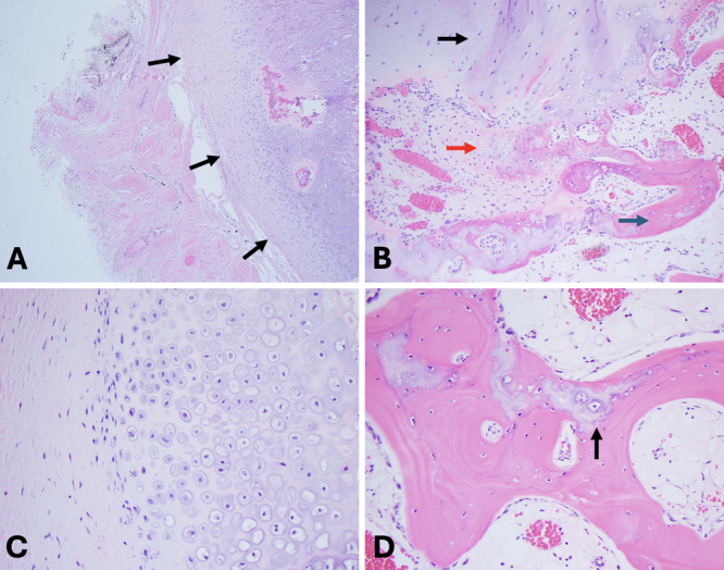 Extraskeletal para-articular osteochondroma adjacent to the cervical spine: illustrative case.