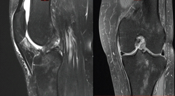 Inverted Cyclops Lesion Following Anterior Cruciate Ligament Repair: A Case Report.