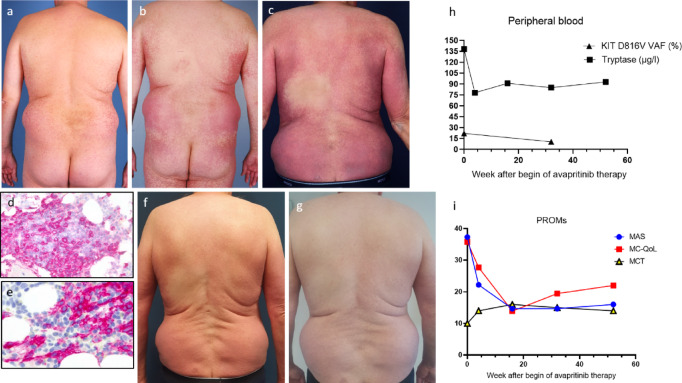Avapritinib reduces symptoms and mast cell burden in systemic mastocytosis.