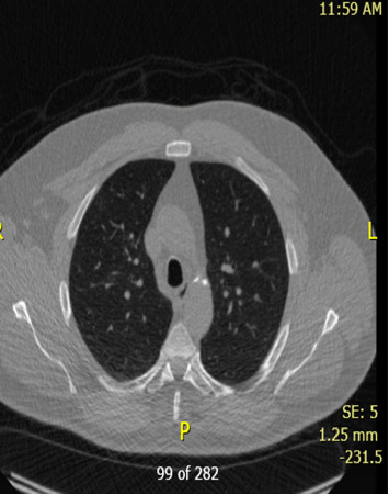 Pulmonary Aspergillosis Mimicking Metastatic RCC: A Postnephrectomy Diagnostic Consideration.
