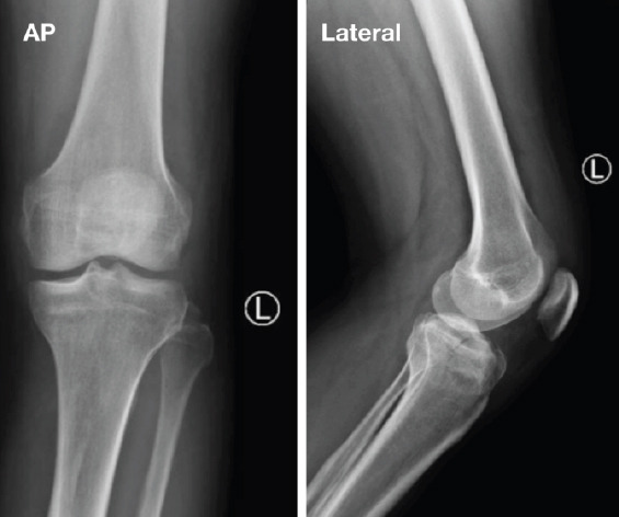 Anteromedial Tibia Plateau Fracture without Significant Ligamentous Injury Treated Successfully with Open Reduction and Internal Fixation: A Case Report.