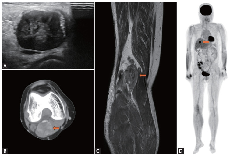 Leiomyosarcoma at popliteal vein presented as unilateral leg edema in a patient with kidney transplantation.