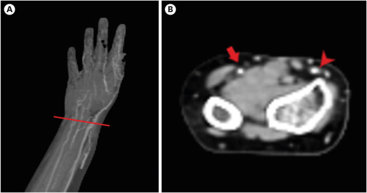 Is the Modified Allen's Test a Useful Tool for Evaluating the Vascular Dominance of the Forearm?