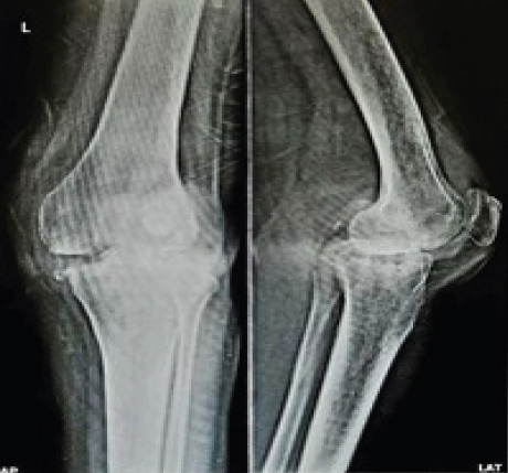 Total Knee Arthroplasty in Tuberculous Arthritis of the Knee - A Case Report.