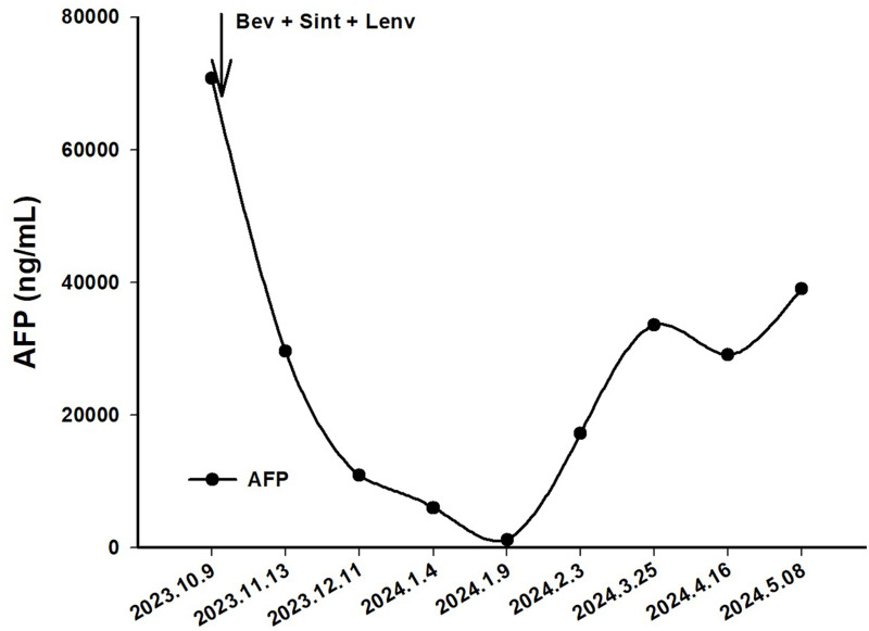 Durable Control of Multi-Refractory HBV-HCC with Bevacizumab/Sintilimab/Lenvatinib Triplet Therapy.