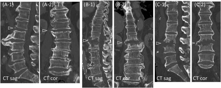 Successful treatment of pyogenic spondylitis in a non-ankylosing lesion of diffuse idiopathic skeletal hyperostosis using penetrating endplate screws: a three-case report.