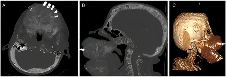 Severe consequences of uncontrolled tertiary hyperparathyroidism in a limited resources setting: a case report.