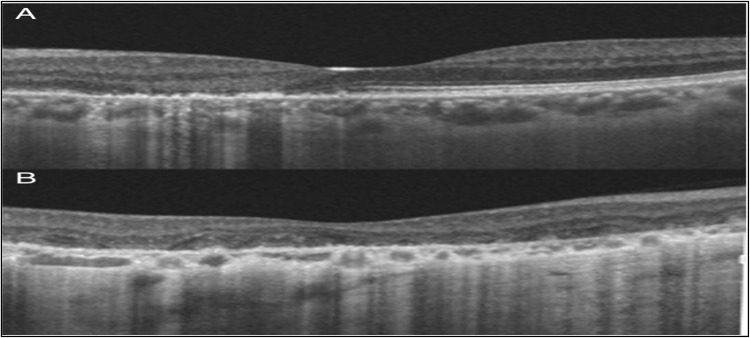 The Role of Adding Intravitreal Dexamethasone Implant to the Standard Management of Serpiginous Choroiditis for Achieving Rapid Remission: A Case Report.