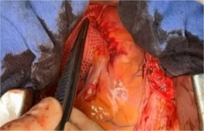 Personalized External Aortic Root Support (PEARS) in the Treatment of Marfan Syndrome and Bicuspid Aortic Valve Aneurysms: First Case Series in the American Continent.