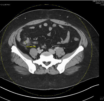 Acute Appendicitis Secondary to Intestinal Schistosomiasis.