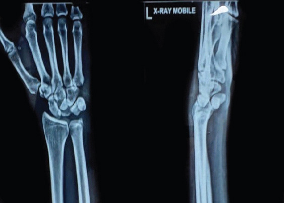 Neglected Isolated Lunate Dislocation in a Polytrauma Patient Presenting as Acute Carpal Tunnel Syndrome - A Case Report with Review of Literature.