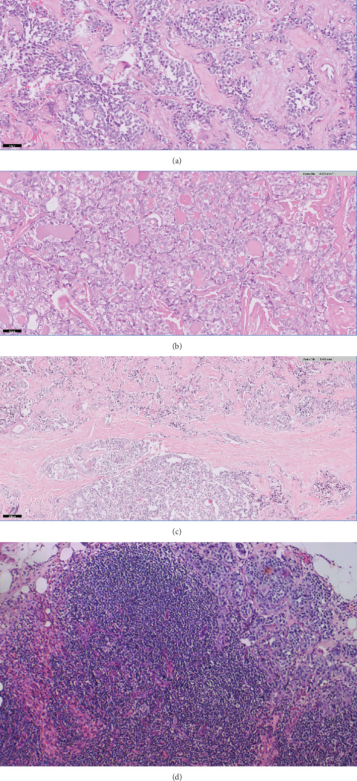 Multifocal Medullary and Papillary Thyroid Carcinoma Occurring as a Collision Tumor: A Case Report.