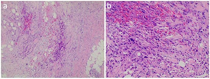 Metastatic epithelioid sarcoma on the arm: presentation of a case report.